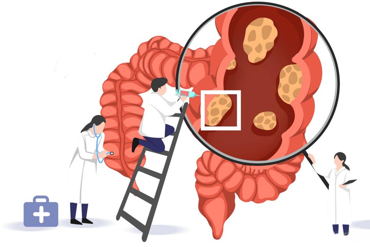 腹泻几天确诊结肠癌,上门取货_123随叫随到
