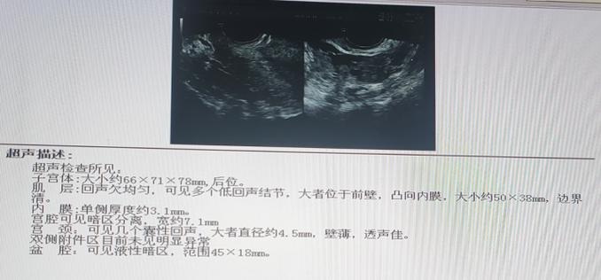 39岁长36枚子宫肌瘤,专业的一站式物流信息网_123随叫随到