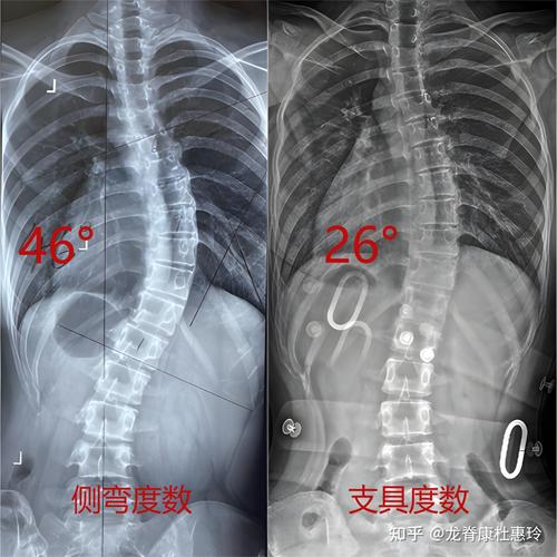 女孩脊柱侧弯80度,专业的一站式物流信息网_123随叫随到